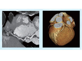 心臓冠動脈CT検査の写真